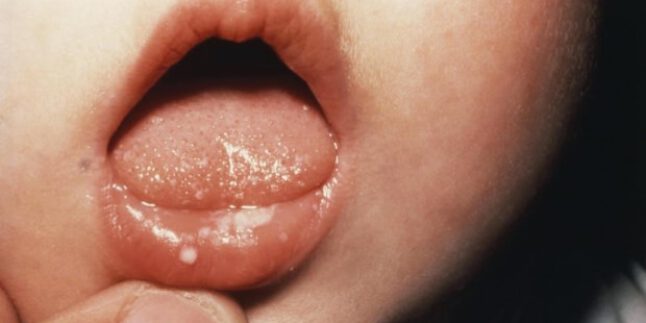 4 aylık bebeğimin ağzında beyaz yaralar oluşmuş ne yapmalıyım ?